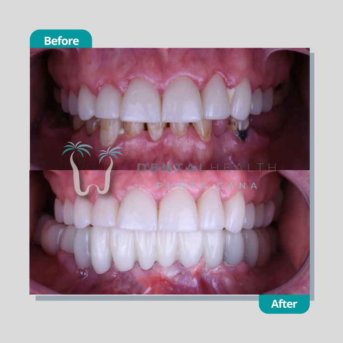 Dental Health Punta Cana Strategic Implants Same Day Implant