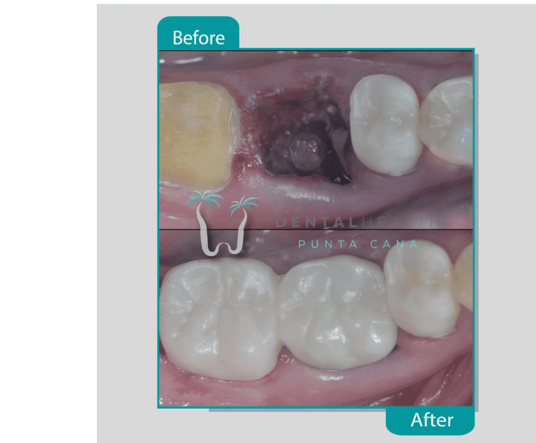 Punta Cana Dental Health Dental Implant