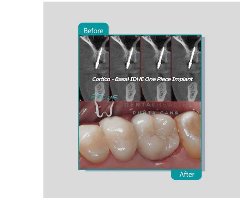 Punta Cana Dental Health Dental Implant